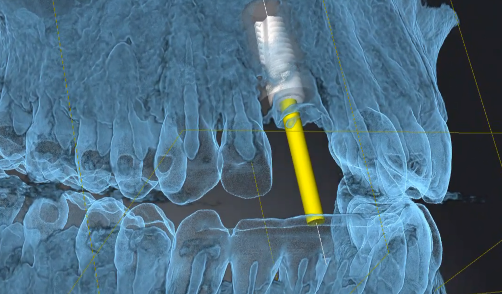 digital imaging of dental implant